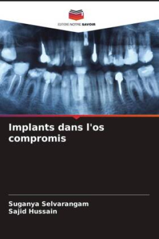 Knjiga Implants dans l'os compromis Sajid Hussain
