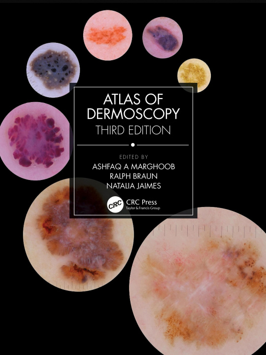 Kniha Atlas of Dermoscopy 