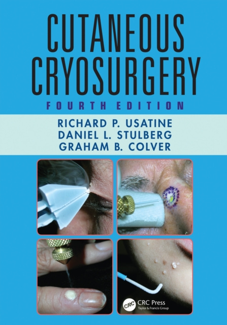 E-Book Cutaneous Cryosurgery Richard P. Usatine