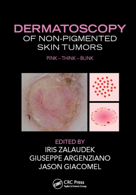 E-kniha Dermatoscopy of Non-Pigmented Skin Tumors Iris Zalaudek