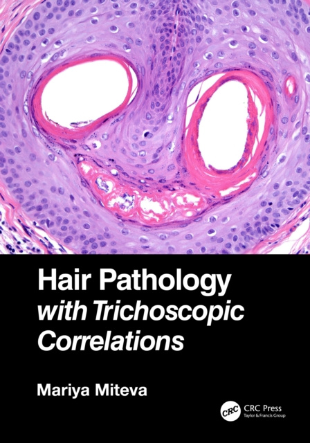 E-knjiga Hair Pathology with Trichoscopic Correlations Mariya Miteva
