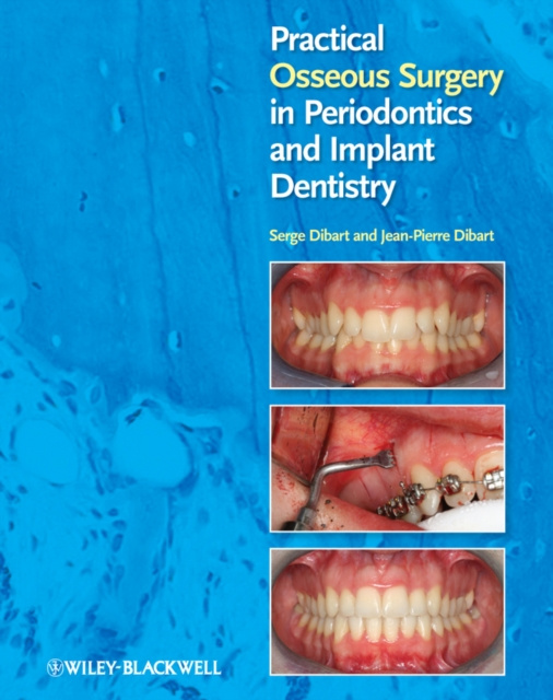 E-kniha Practical Osseous Surgery in Periodontics and Implant Dentistry Serge Dibart