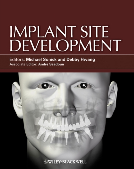 E-book Implant Site Development Michael Sonick