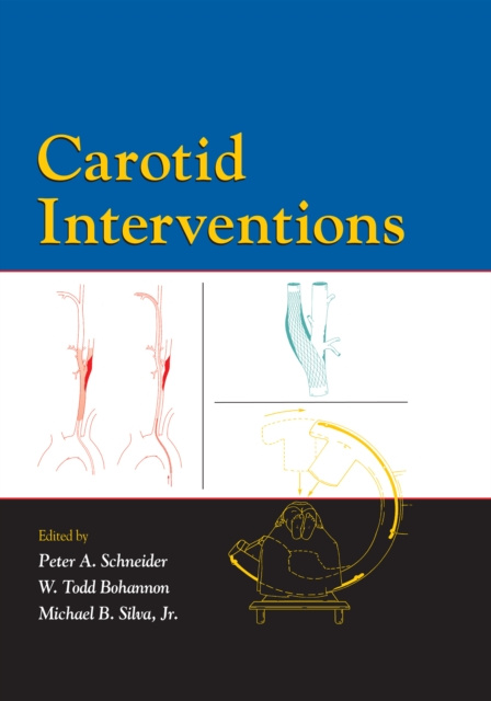 E-book Carotid Interventions Peter Schneider