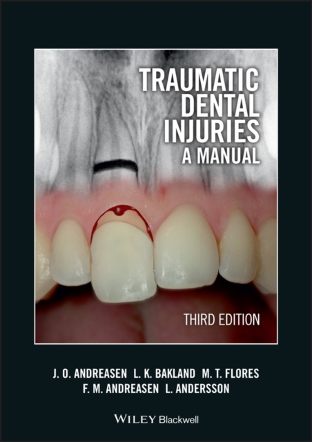 E-knjiga Traumatic Dental Injuries Jens O. Andreasen