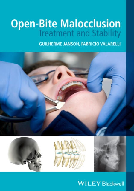 E-book Open-Bite Malocclusion Guilherme Janson