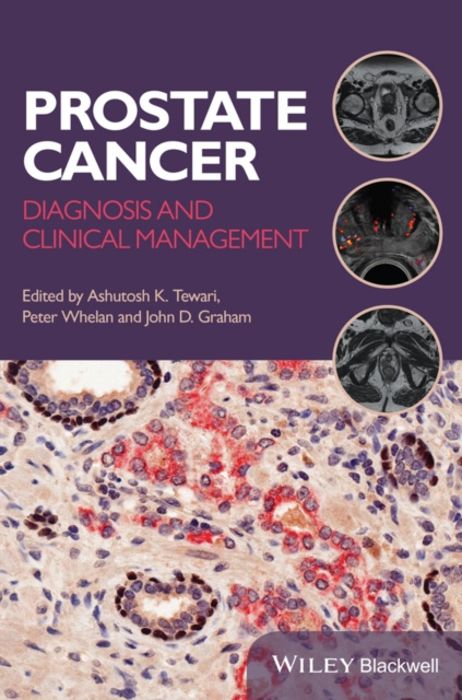 E-book Prostate Cancer Ashutosh K. Tewari
