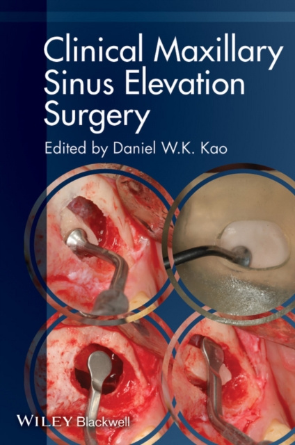 E-book Clinical Maxillary Sinus Elevation Surgery Daniel W. K. Kao