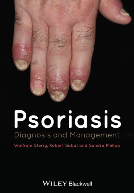 E-book Psoriasis Wolfram Sterry
