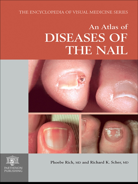 E-kniha Atlas of Diseases of the Nail Phoebe Rich