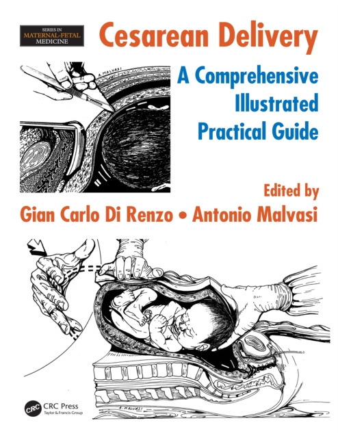 E-book Cesarean Delivery Gian Carlo Di Renzo