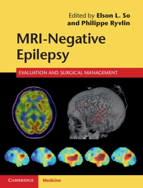 E-book MRI-Negative Epilepsy Elson L. So