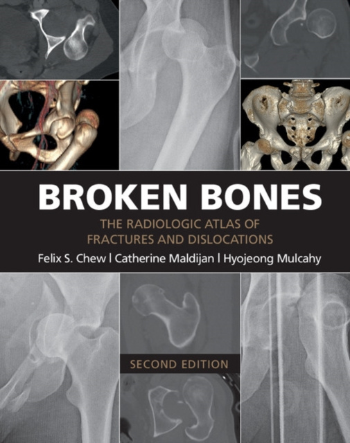 E-knjiga Broken Bones Felix S. Chew
