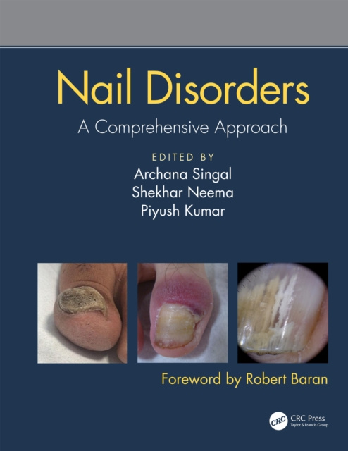 E-kniha Nail Disorders Archana Singal