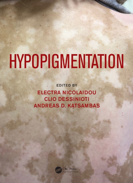 E-knjiga Hypopigmentation Electra Nicolaidou