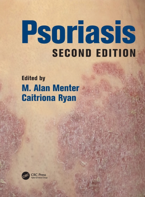 E-book Psoriasis M. Alan Menter