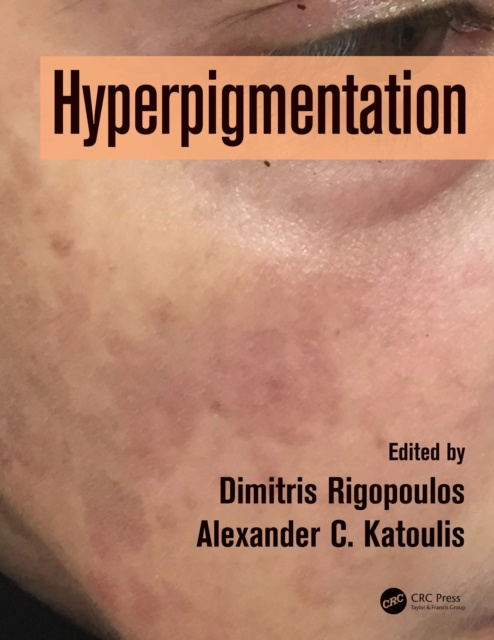 E-knjiga Hyperpigmentation Dimitris Rigopoulos