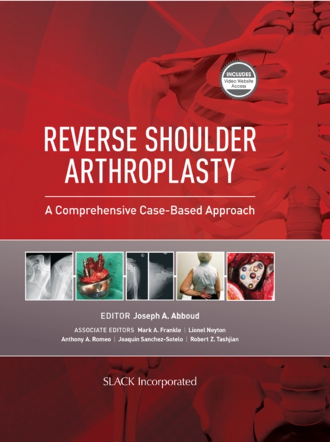 E-kniha Reverse Shoulder Arthroplasty Joseph A. Abboud