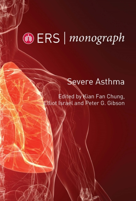E-knjiga Severe Asthma Kian Fan Chung