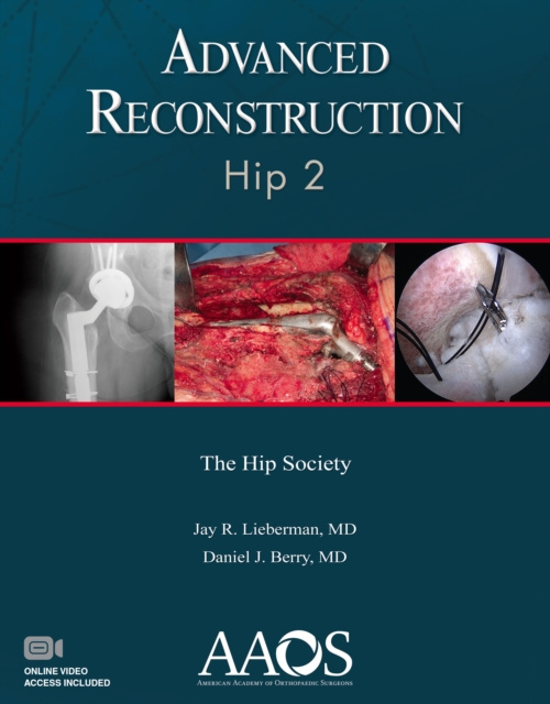 E-book Advanced Reconstruction: Hip 2 MD Jay R. Leiberman
