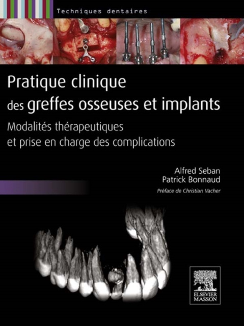 E-kniha Pratique clinique des greffes osseuses et implants Alfred Seban