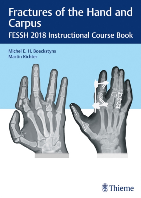 E-kniha Fractures of the Hand and Carpus Michael E. H. Boeckstyns