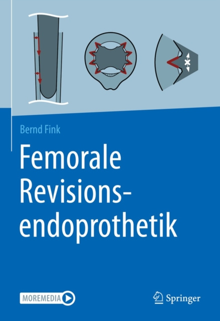 E-book Femorale Revisionsendoprothetik Bernd Fink