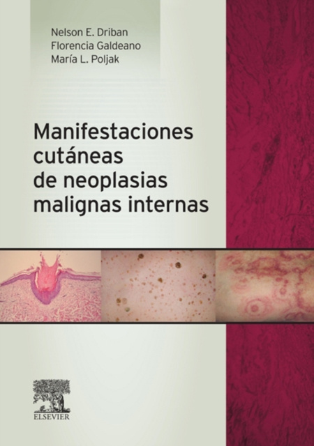 E-kniha Manifestaciones cutaneas de neoplasias malignas internas Nelson Edgardo Driban