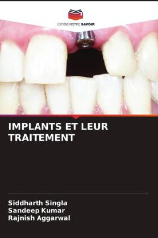 Boek IMPLANTS ET LEUR TRAITEMENT Sandeep Kumar