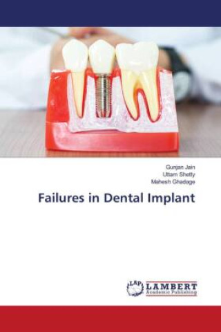 Book Failures in Dental Implant Uttam Shetty