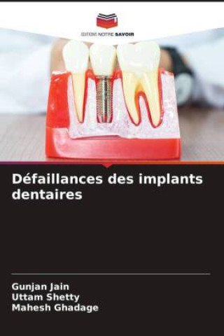 Carte Défaillances des implants dentaires Uttam Shetty