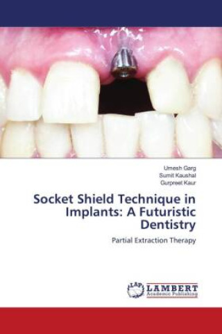 Kniha Socket Shield Technique in Implants: A Futuristic Dentistry Sumit Kaushal