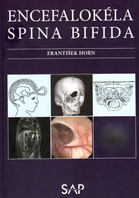 Kniha Encefalokéla spina bifida František Horn