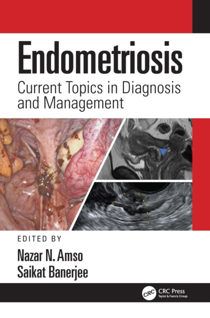 E-knjiga Endometriosis Nazar Amso