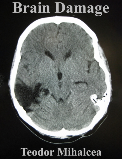 E-knjiga Brain Damage Teodor Mihalcea