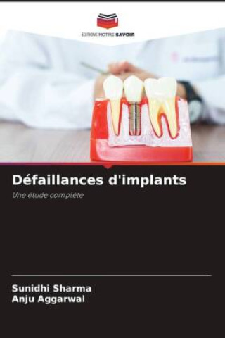 Knjiga Défaillances d'implants Anju Aggarwal