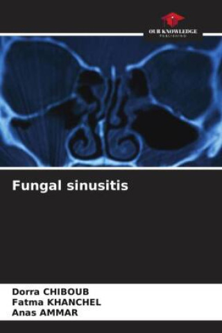 Knjiga Fungal sinusitis Fatma Khanchel