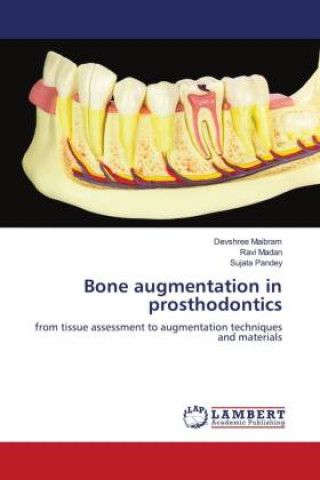 Kniha Bone augmentation in prosthodontics Ravi Madan