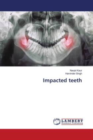 Knjiga Impacted teeth Harvinder Singh