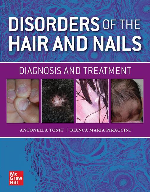 Kniha Disorders of the Hair and Nail: Diagnosis and Treatment Bianca Maria Piraccini