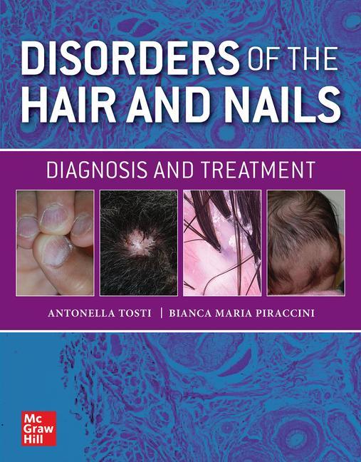 Book Disorders of the Hair and Nail: Diagnosis and Treatment Bianca Maria Piraccini