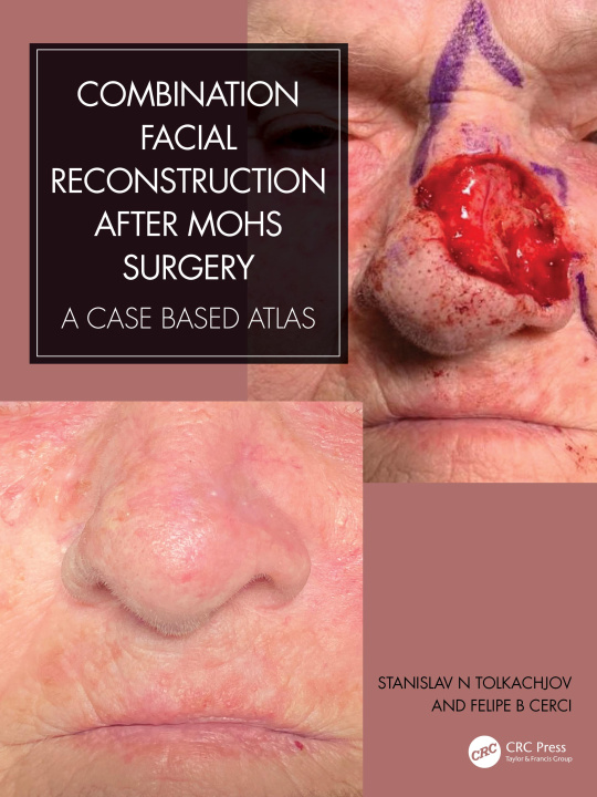 Kniha Combination Facial Reconstruction after Mohs Surgery Tolkachjov