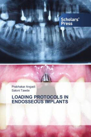 Knjiga LOADING PROTOCOLS IN ENDOSSEOUS IMPLANTS Saloni Tawde