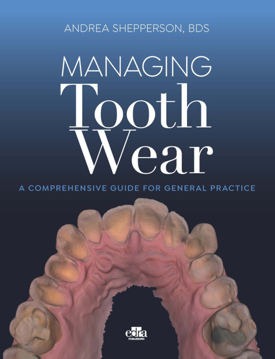 Book Managing tooth Wear. A comprehensive guide for general practice Andrea Shepperson