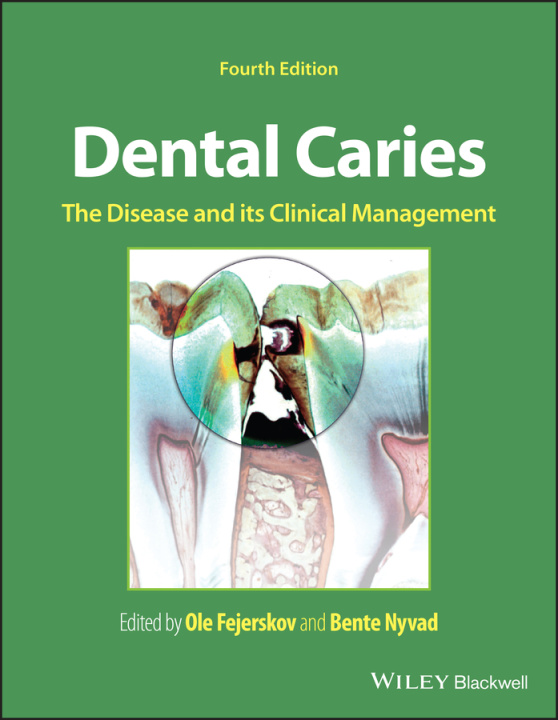 Knjiga Dental Caries: The Disease and its Clinical Manage ment 4th Edition 