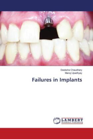 Knjiga Failures in Implants Manoj Upadhyay