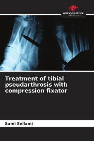 Kniha Treatment of tibial pseudarthrosis with compression fixator Mohamed Ali Rekik