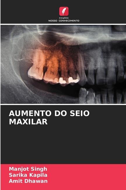 Libro AUMENTO DO SEIO MAXILAR Sarika Kapila