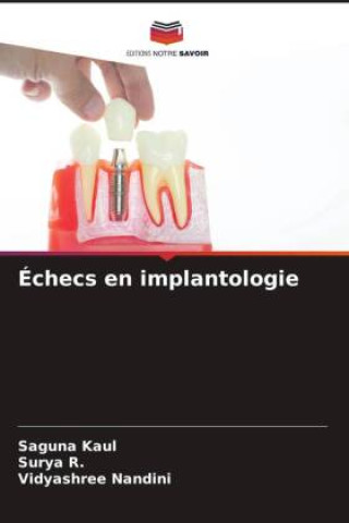 Kniha Échecs en implantologie Surya R.