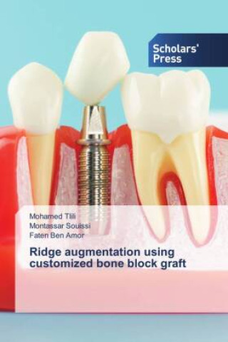 Kniha Ridge augmentation using customized bone block graft Montassar Souissi